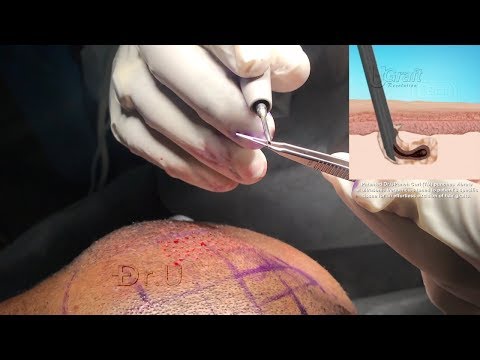 Dr. Sanusi Umar Makes Another Breakthrough in FUE Technology with Dr.UGraft™ Ultrasonic Hair Transplant