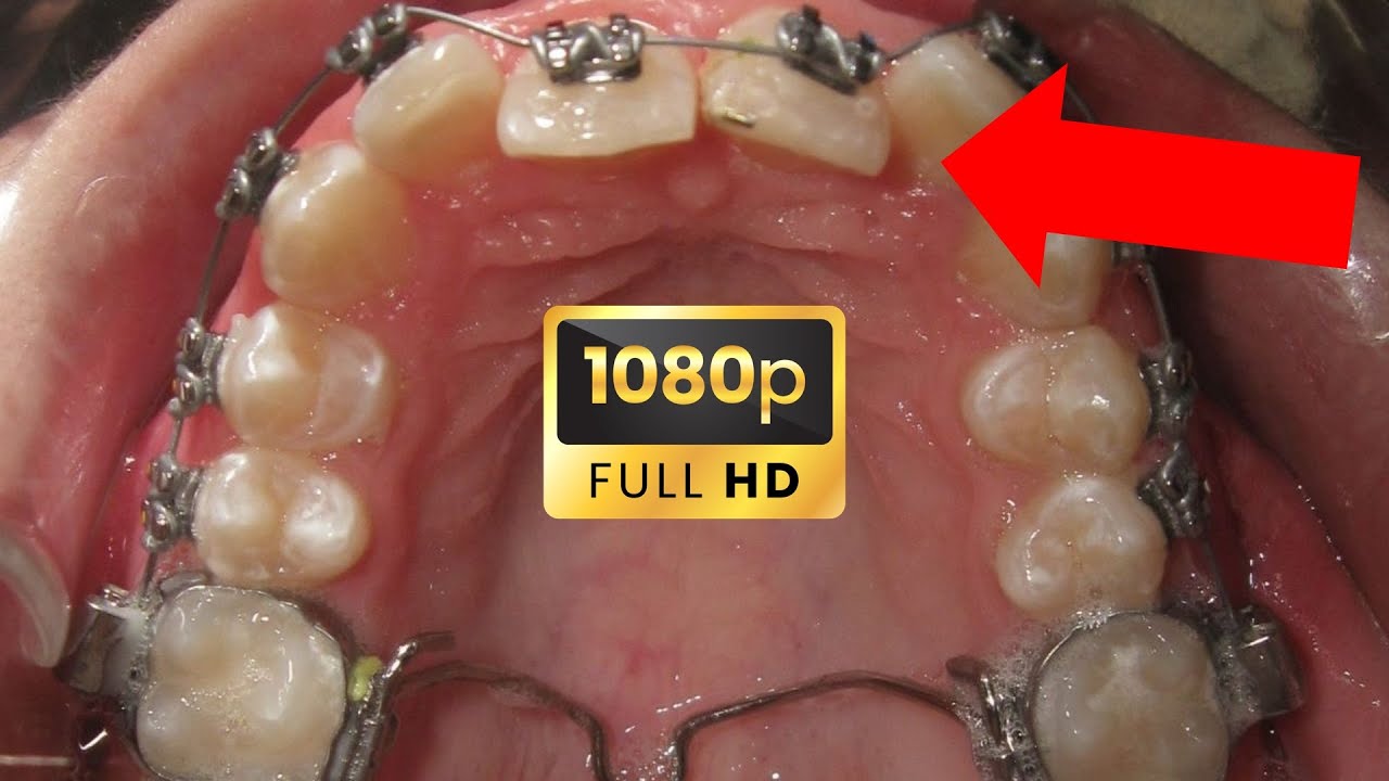 GUMMY SMILE and DEEP OVERBITE TMD! HOW BRACES WORK YouTube