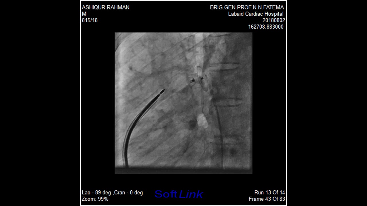Ashfaq Ahmed 16 Yrs 50 kg Large PDA Device closure done by 12 x 10 Cookon Device