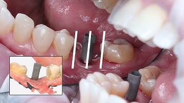 5 Steps to Successful Implant Scanning
