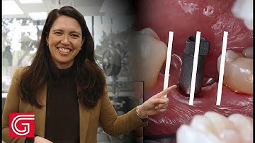 5 Steps to Successful Implant Scanning