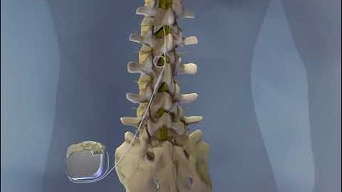 Dr. Georgios Matis - Neuromodulation - Spinal Cord Stimulation - Instructional video - Background