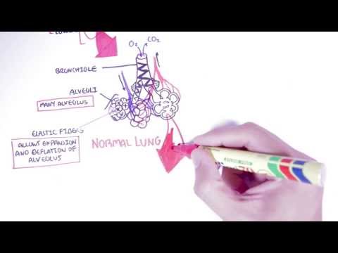 Emphysema - Introduction, Types, Symptoms, Diagnosis