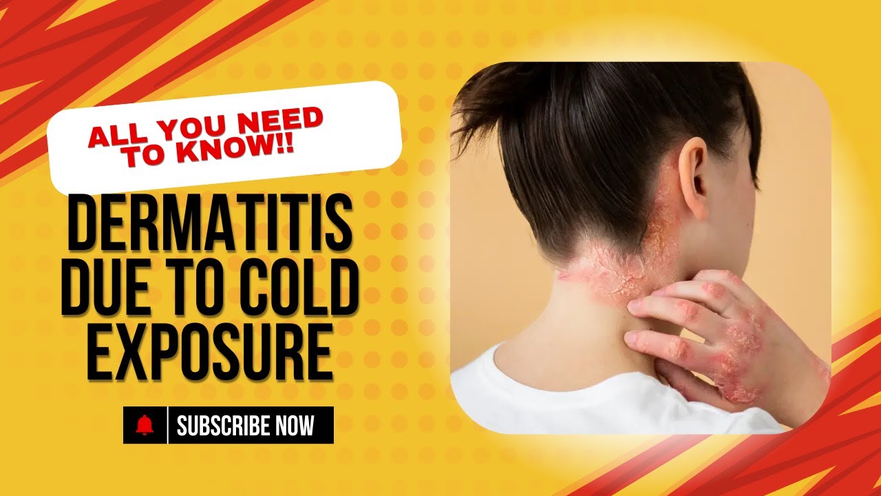 Myths about Dermatitis due to cold exposure🤯 - YouTube