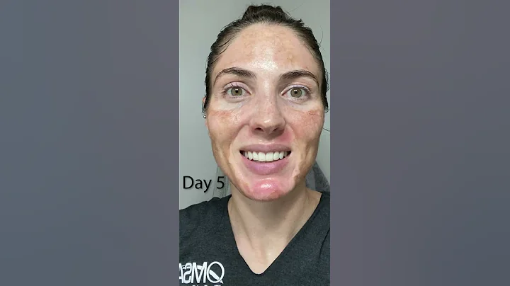 20% TCA Chemical Peel - Wait until the end!  Results before your eyes. Melasma & acne scar treatment - DayDayNews