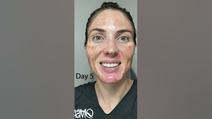 20% TCA Chemical Peel - Wait until the end!  Results before your eyes. Melasma & acne scar treatment