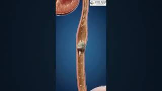 Can a 4mm Kidney Stone Pass Naturally? 🛑 (Percentage Breakdown)