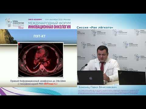 Современные стандарты хирургического лечения рака легкого.