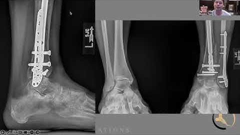 Distal tib/fib fractures -  IM nailing tips and tricks