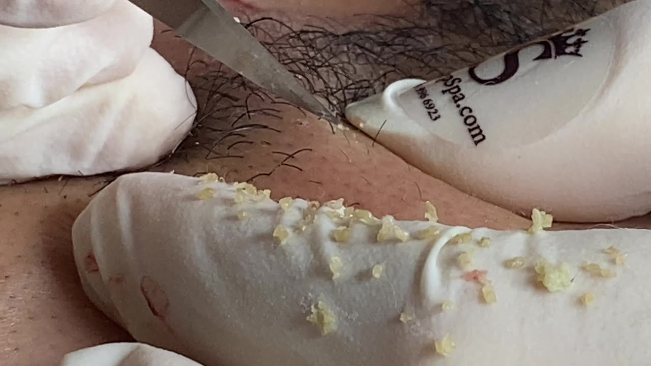 Remove Blackhead | Loại  Sạch Mụn Đầu Đen - SacDepSpa#99