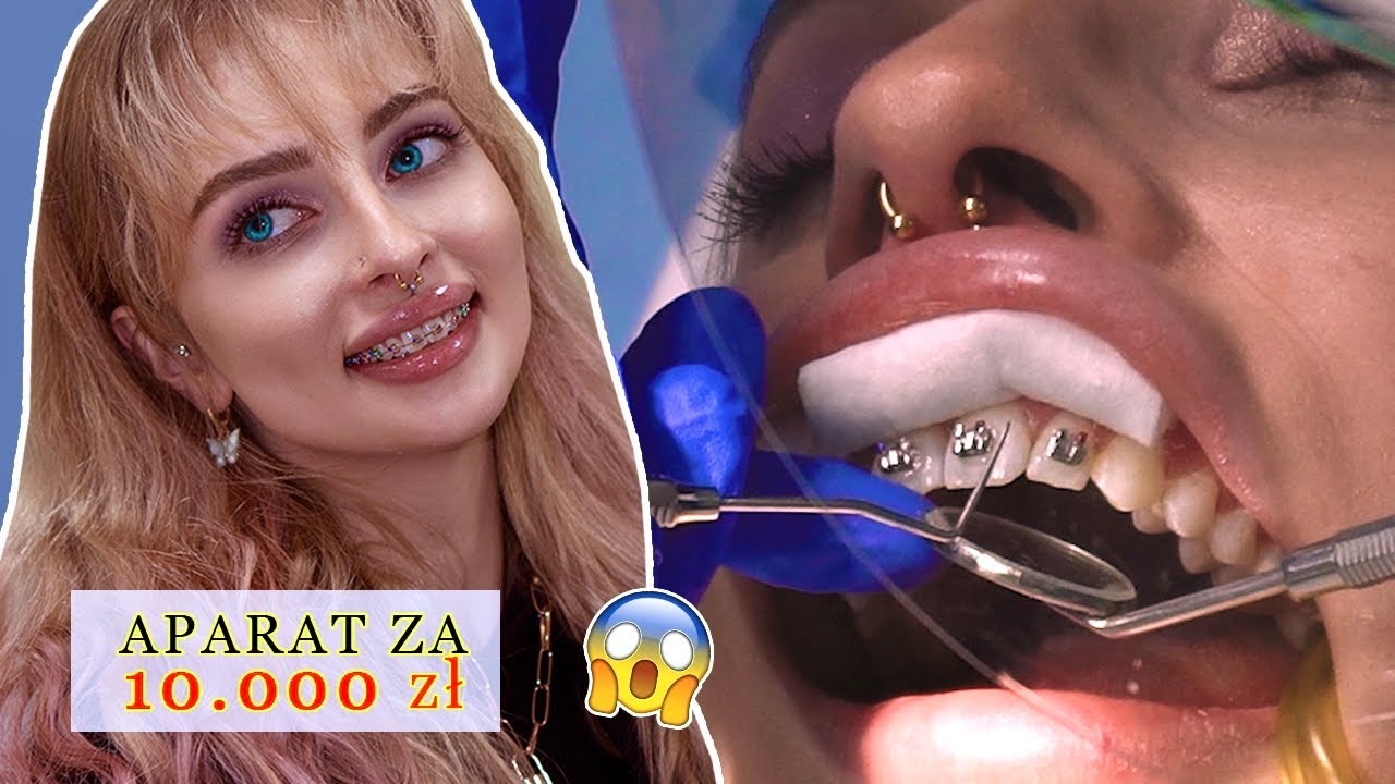 ZAKŁADAM APARAT ORTODONTYCZNY - CAŁY PROCES - CENA, BÓL, EFEKTY