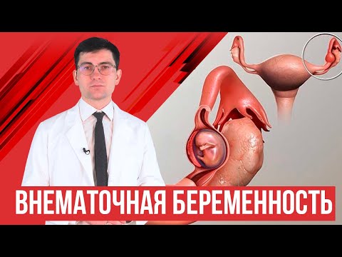 Внематочная беременность. Что делать и какие последствия?