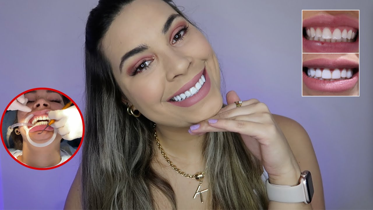 MINHAS FACETAS/LENTES EM RESINA COMPOSTA