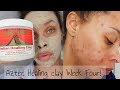 WEEK FOUR - I TRIED THE AZTEC HEALING CLAY - ACNE PRONE SKIN