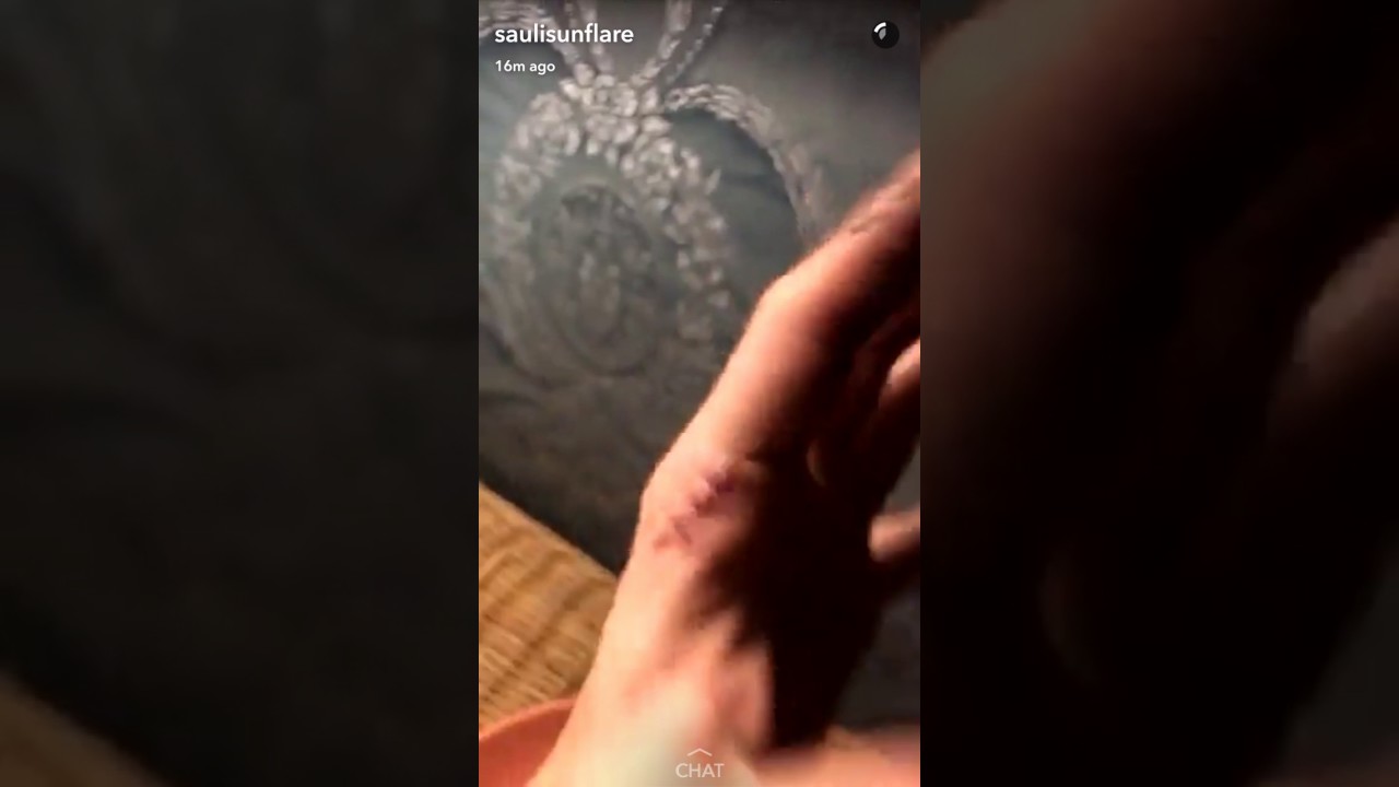 Poor Sauli's knife wound - 12.12.2016 - YouTube