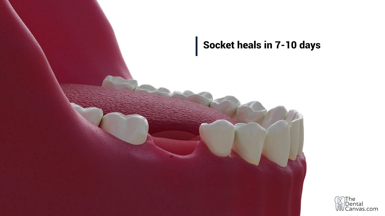 Extraction Dental Procedures YouTube