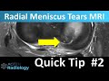 Quick tip #2 Radial Meniscus Tears on knee MRI