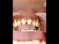Smile Designing front teeth zirconia