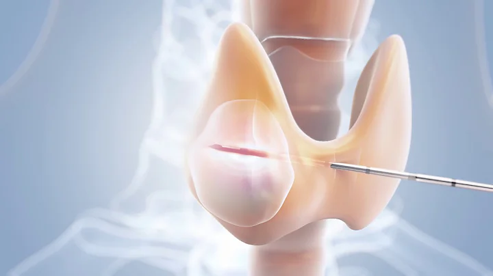 Bipolar RFA of Thyroid Nodules with the CELON Power System - Animation