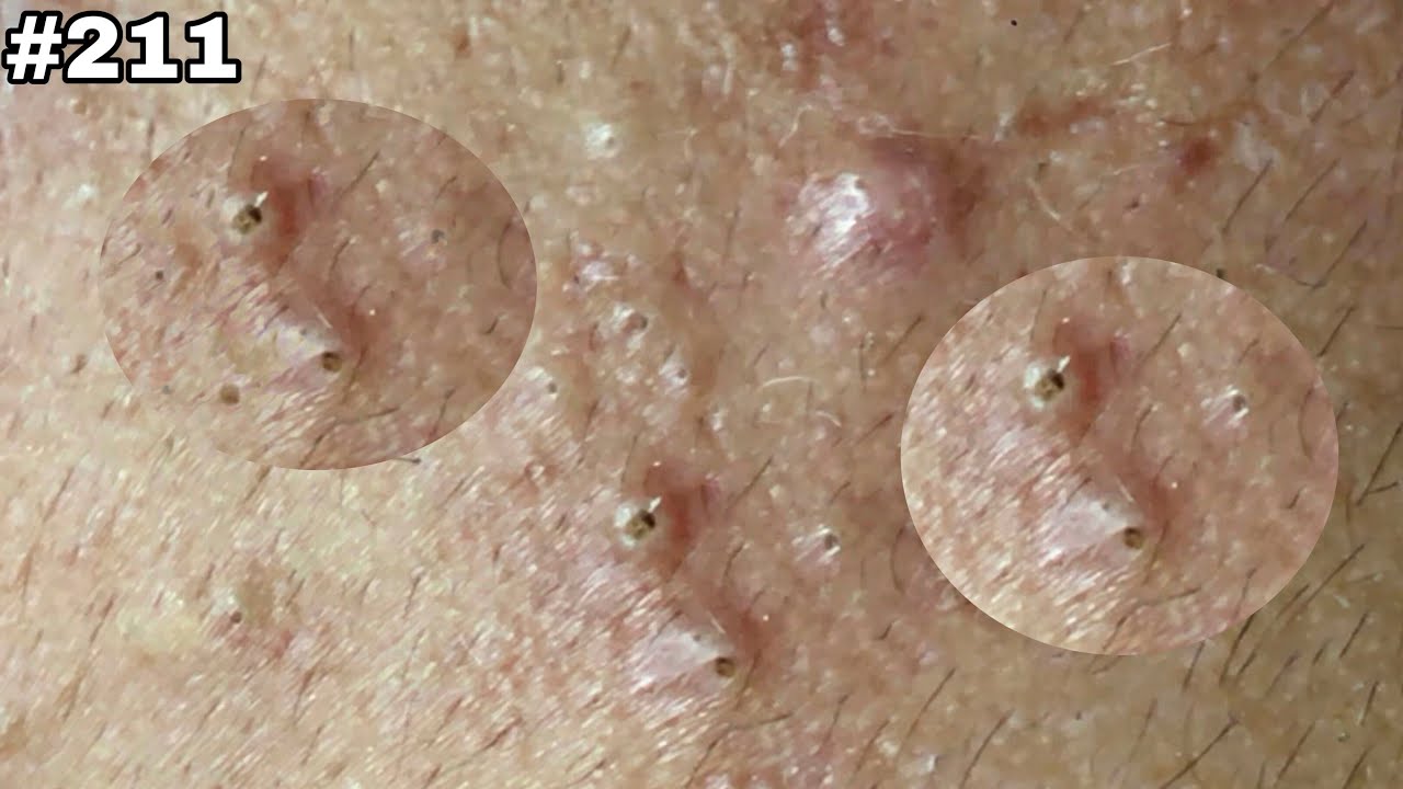 #211. remove large blackheads (long time) | @Quyet_Tran_Official_2.
