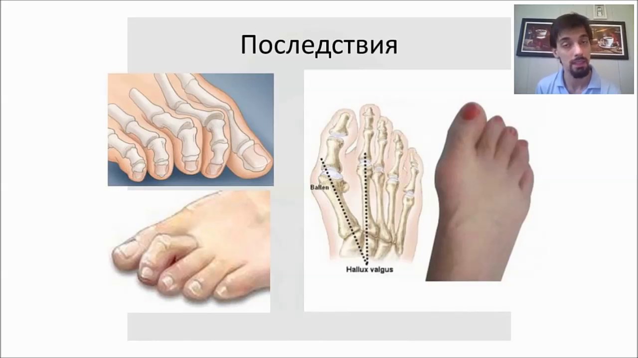 Вебинар "Коррекция плоско-вальгусной деформации стоп у детей" #ПВУС # ...