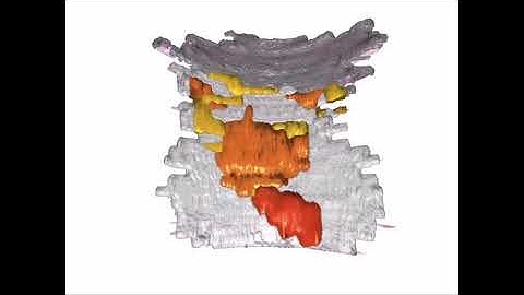 Virtual Endoscopy Based on 3-Dimensional Reconstruction of Histopathology Features of Endoscopic...