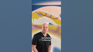 Ultimate Pain in the Buttocks 🔪 #shorts #pilonidal