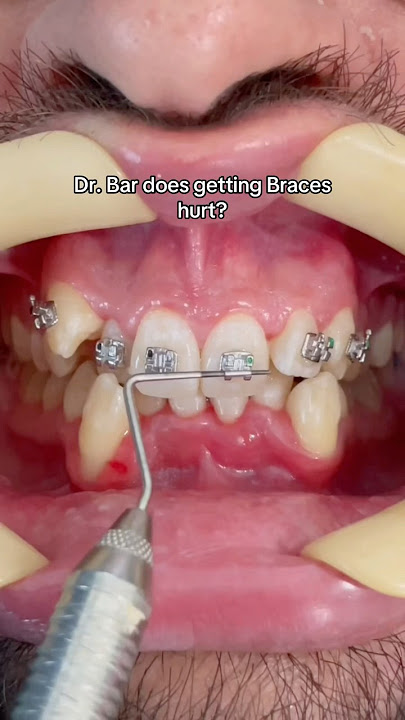 Does Getting Braces Hurt? Here's the Truth!