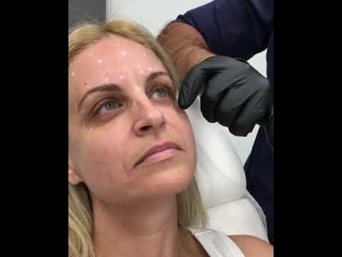 Botox & Υαλουρονικό για τις ρυτίδες στο πρόσωπο και τους μαύρους κύκλους