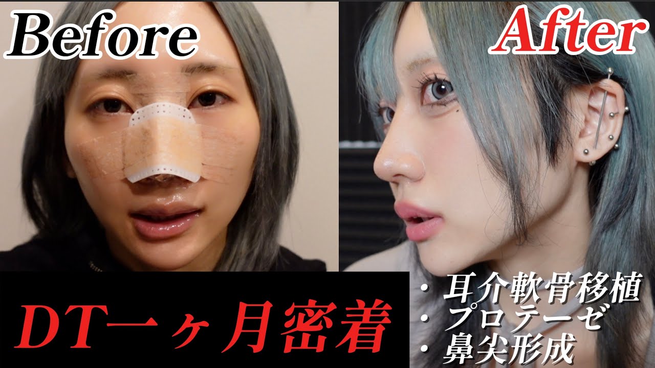 【鼻整形】ダウンタイム一ヶ月まとめ｜プロテーゼ＋耳介軟骨移植＋鼻尖形成