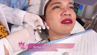 Ultra V Lift for face slimming and face contouring