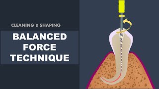Balanced Force Technique | Cleaning and Shaping