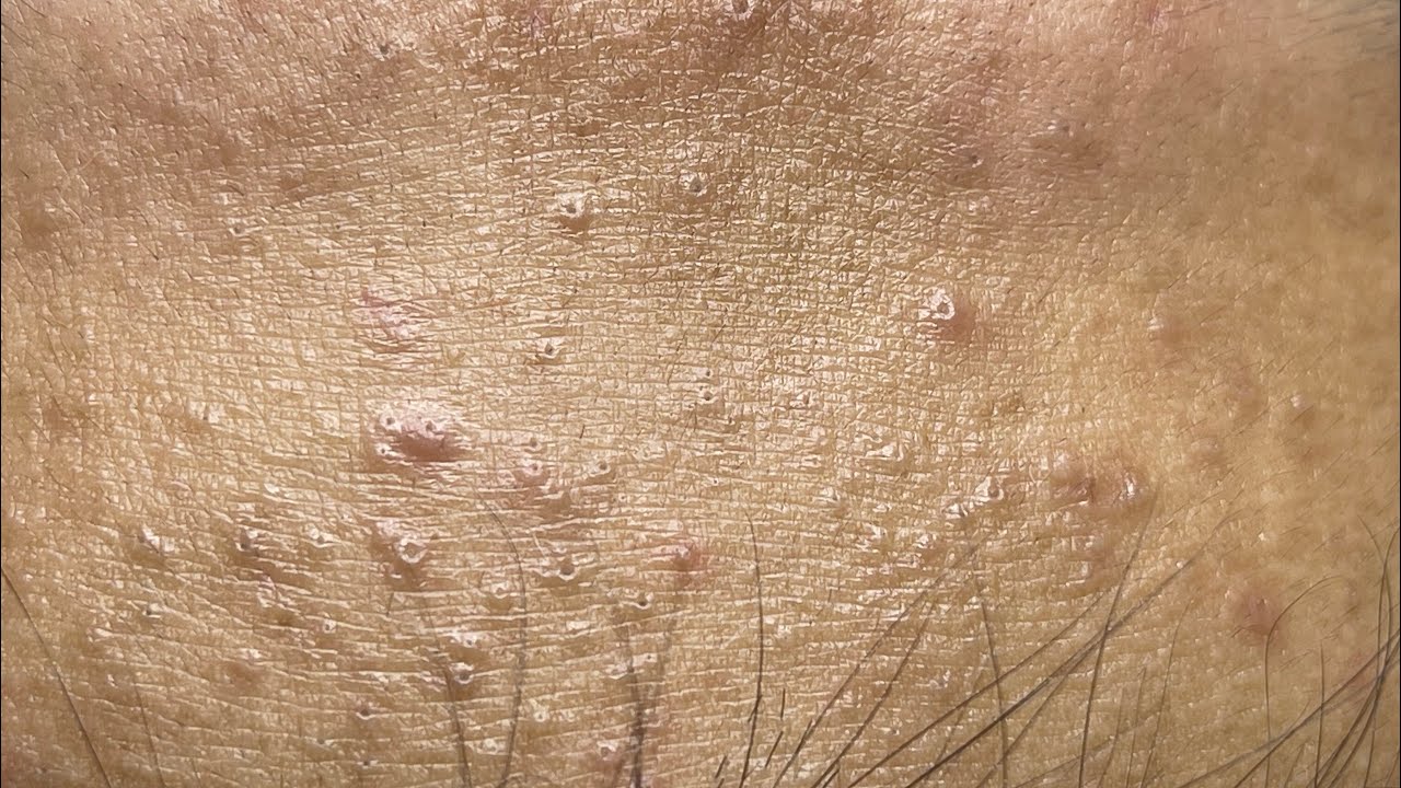 Relaxing acne treatment with Linh My Dang #327  (Linh My Dang)