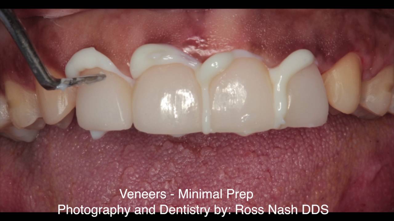 Veneers Minimal Prep Ross Nash DDS YouTube