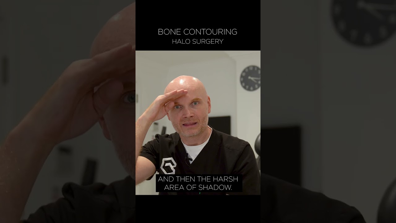 Bone Contouring - Hairline Lowering Surgery | 