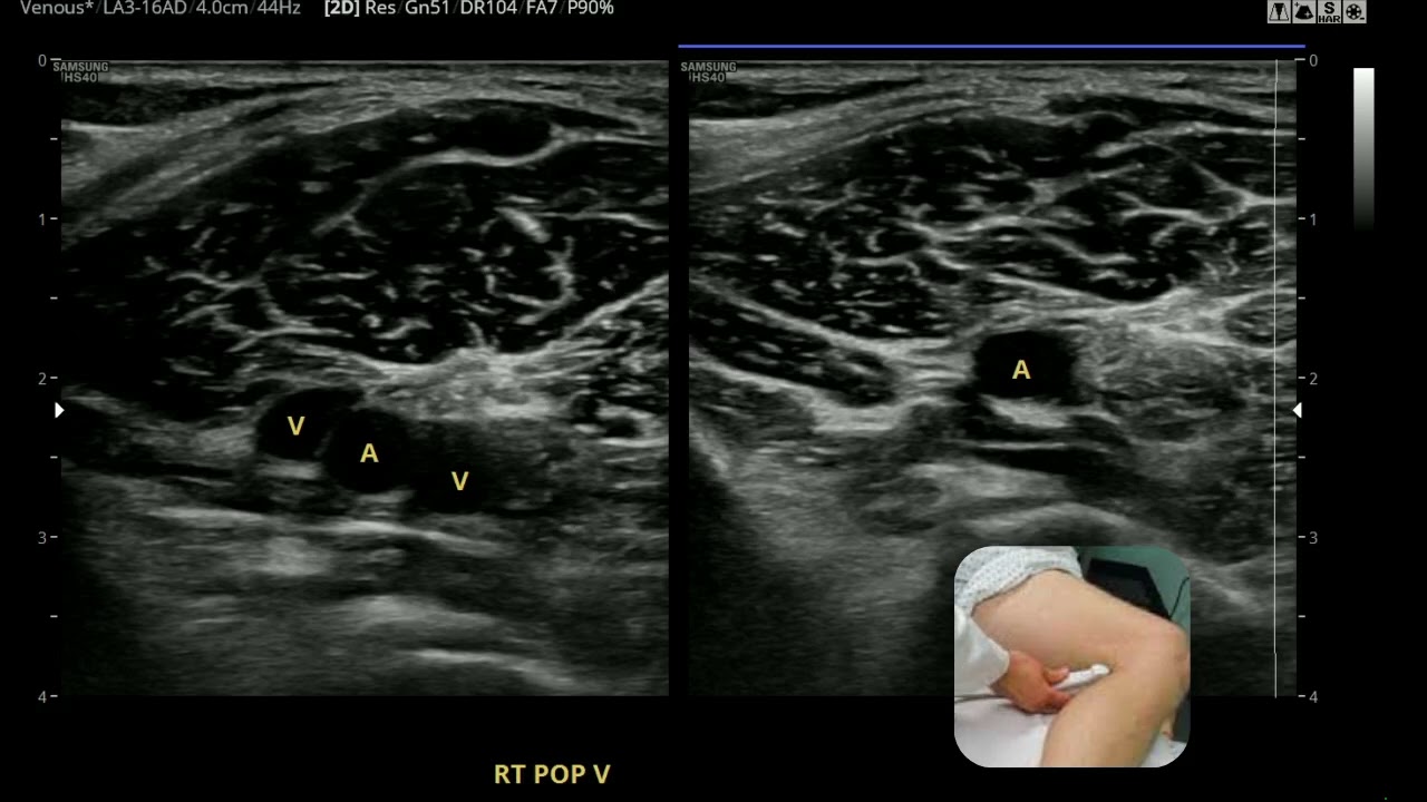 Lower Extremity Venous, Crystal Tena & Emily Mouland