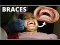 Nagpa BRACES ang ate Gurl! (Tiis ganda!) | philippines [VLOG 006]