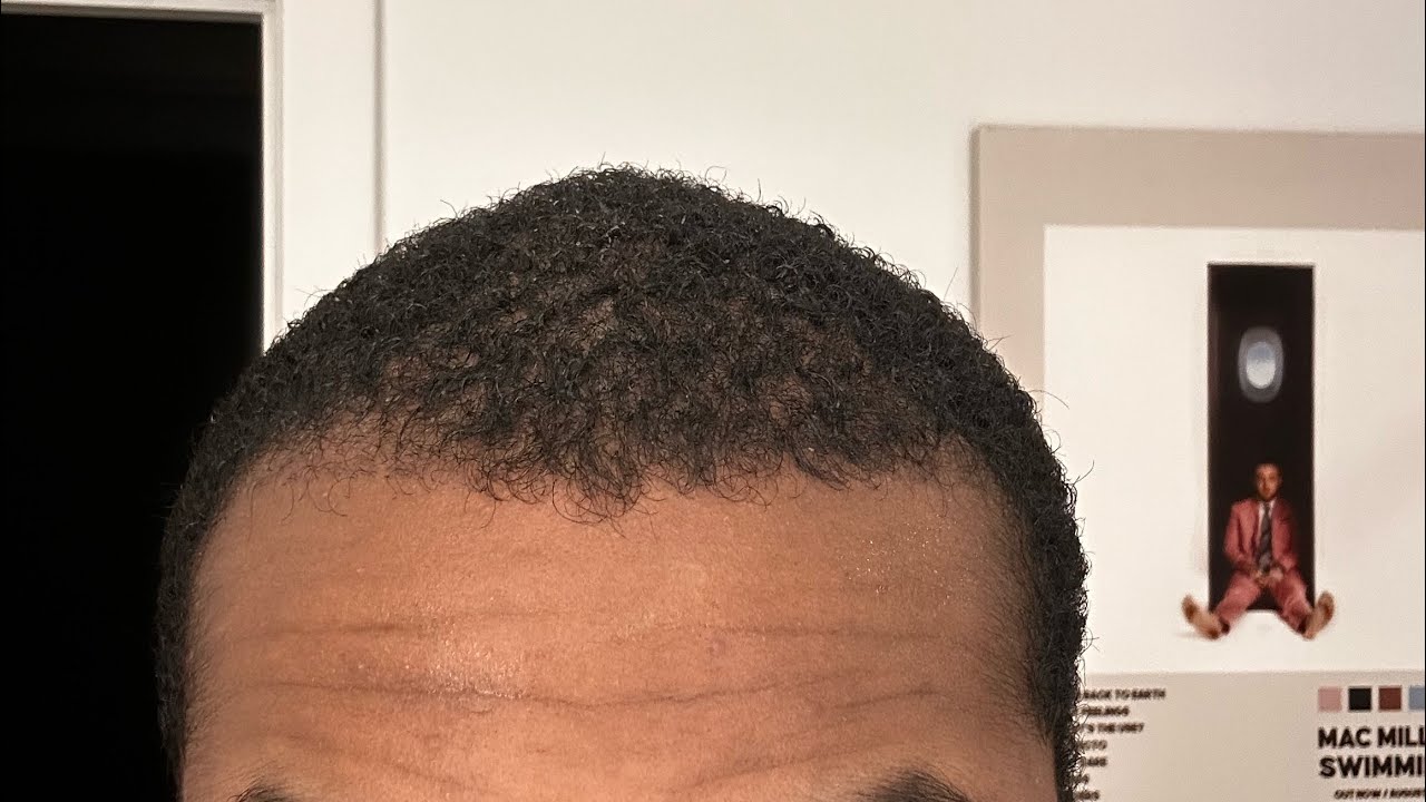 2 month update. Hair transplant at Heva Clinic - Istanbul. 