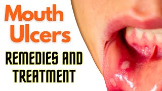 Mouth Ulcers: Effective Treatment Options  | Effective and Natural Treatment for Mouth Ulcers