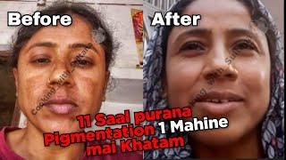 11 SAAL PURANA PIGMENTATION 1 MAHINE mai KHATAM | Cooking with Sultana 