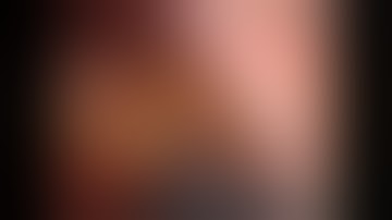 Robotic low anterior resection (LAR) (ICG in nodes)