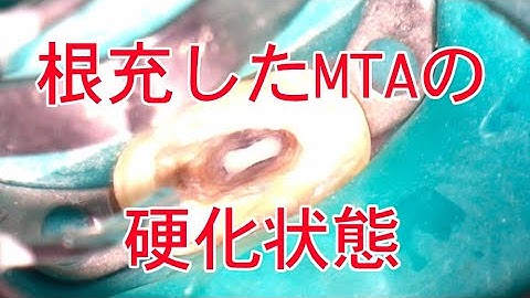 根管充填したMTAの硬化状態