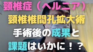 頸椎症（ヘルニア）で頸椎椎間孔拡大術を受け1年以上経過した結果をお伝えします！Cervical spondylosis　Results of surgery