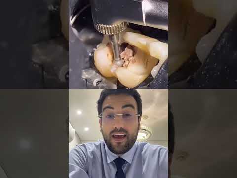 Vídeo: Como tolerar que os dentes do siso sejam arrancados (com fotos)