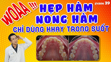 Hẹp Hàm Có Dùng Khay Trong Suốt Được Không ? | Nam Bùi Vinalign