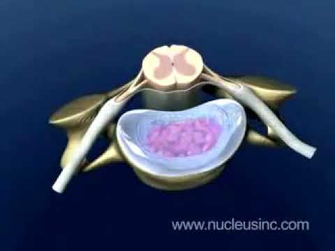 Vídeo: Radiculite Da Coluna Cervical (ciática Cervical)