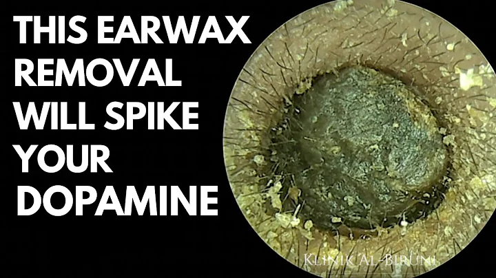 This Earwax Removal Will Spike Your Dopamine