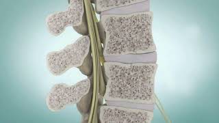 Spinal Stenosis and Spine Surgery | Medical Animation