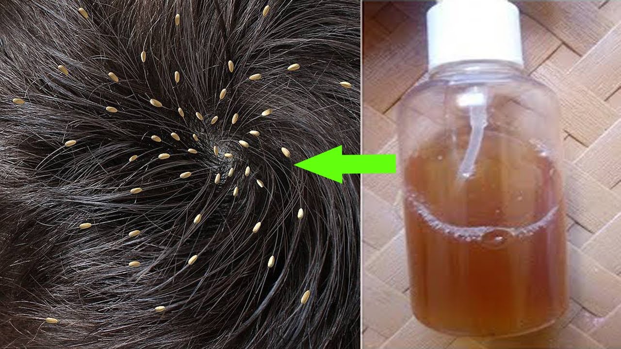 أقوى وصفة لعلاج القمل والصئبان في يوم واحد بدون أدوية أو مواد كيميائية ضارة بالشعر