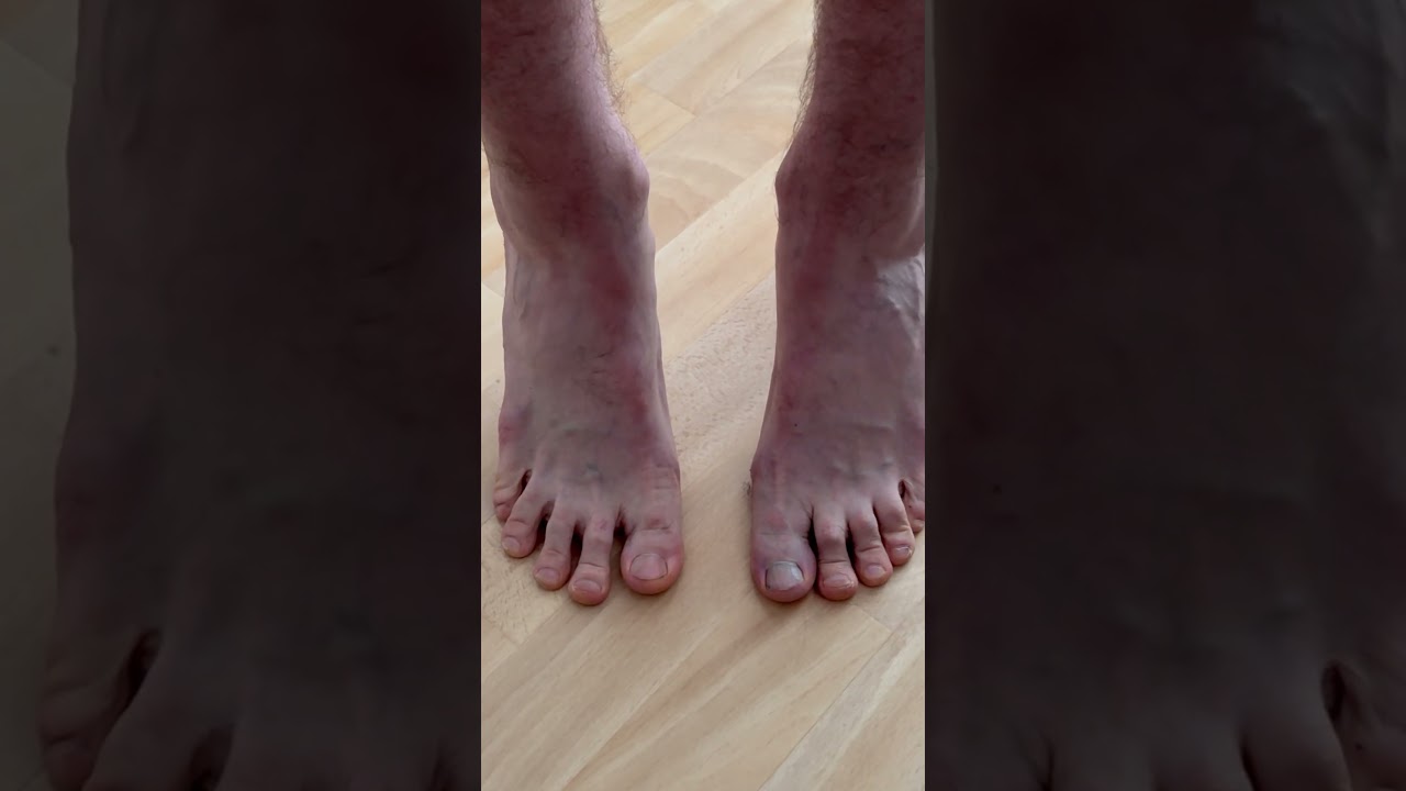 Что НУЖНО делать, если у вас hallux valgus 